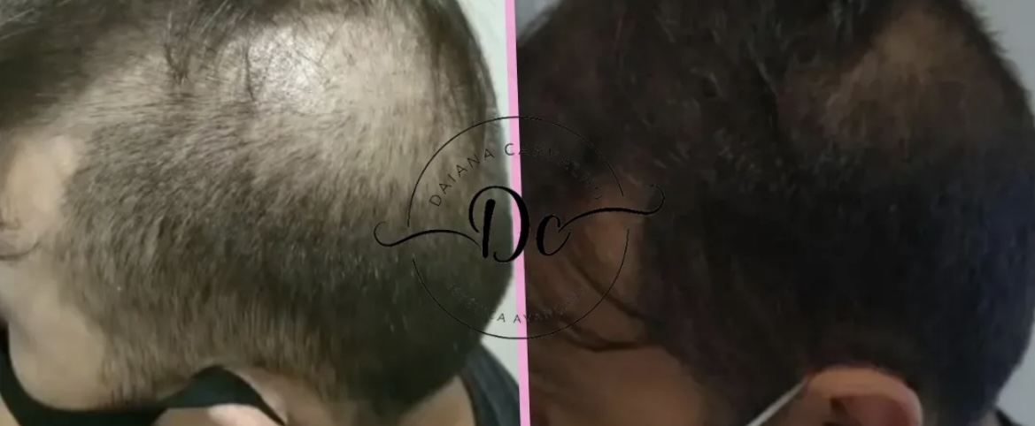 Antes e depois — protocolo para calvície