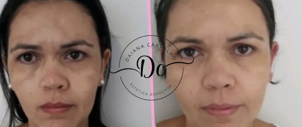 Antes e depois — tratamento para melasma