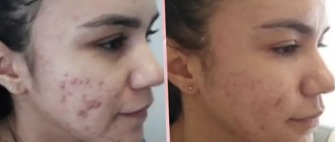 Antes e depois — microagulhamento facial