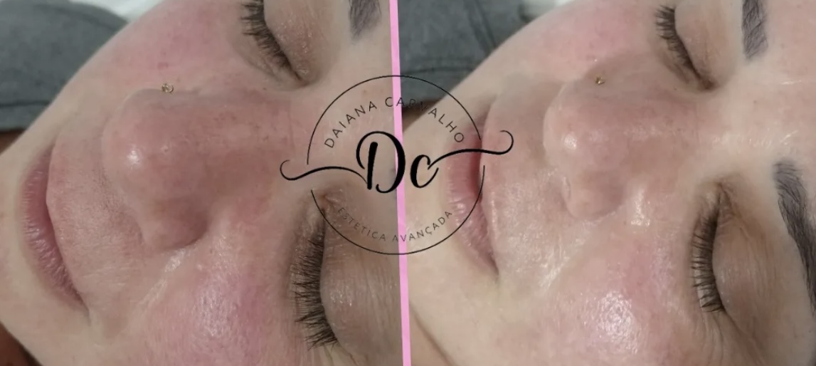 Antes e depois — tratamento para rosácea